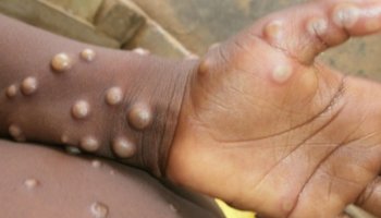 U.S. expands monkeypox testing capacity amid an increase in cases