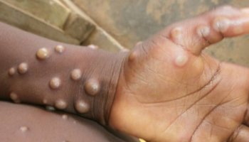 Public health emergency declared over monkeypox outbreak in the US